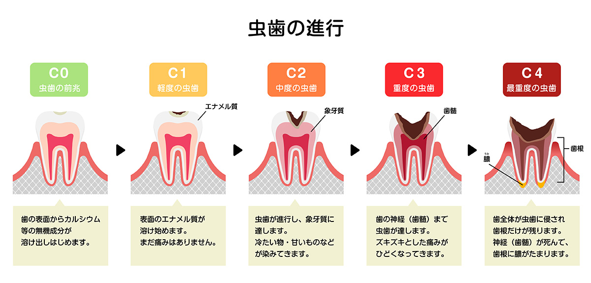 https://piccoluna.com/takarada/wp-content/uploads/2025/09/caries_01.png